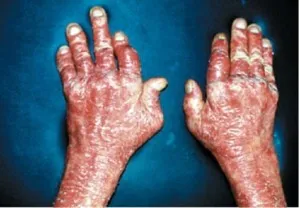 Psoriatica arthropathia, psoriasis kezelésére