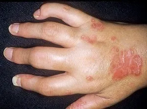 Psoriatica arthropathia, psoriasis kezelésére