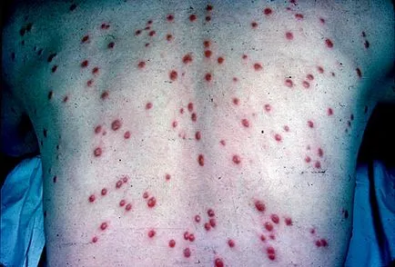 Проявите на сифилис по кожата (кожа) пластири, обриви, сифилитичен лезии; изглежда като