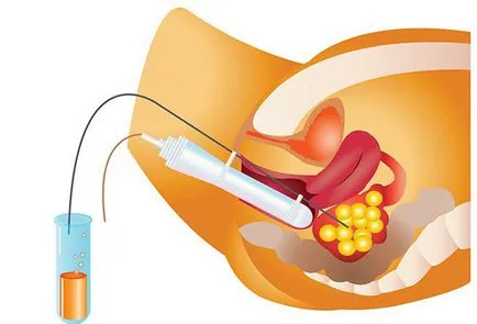 Follicle szúrás eco véleménye, képzés, miután érzés