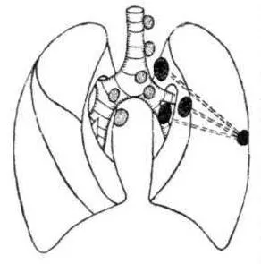 Развитието на туберкулоза - обща патогенеза на туберкулоза - патология - костно-ставните