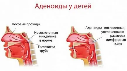 Дете подушва носа, но не и сополи какво да се прави при новороденото