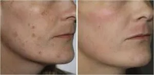 Retinoinsa (Sárga) felülvizsgálata peeling módszer és vélemények