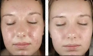 Retinoinsa (Sárga) felülvizsgálata peeling módszer és vélemények