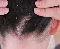 Себорея на кожата на главата от това, което се появява за лечение на шампоани, балсами