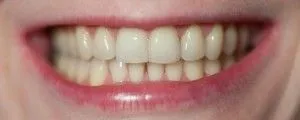 Разделяне на зъбите преди и след