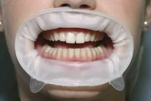 Sapphire zárójelek - különösen költségek előtti és utáni képek - Orvos fogat