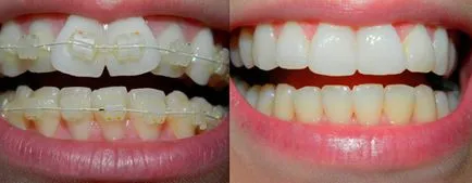Sapphire zárójelek - különösen költségek előtti és utáni képek - Orvos fogat