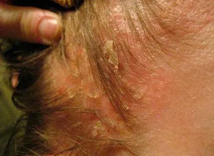 Seborrhoeás dermatitis a fejbőr (kezelés és okai)