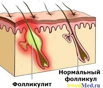 Що підриває фолікуліт Гофмана