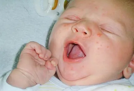 Kiütés az arcon az újszülött okok, kezelési módszerek