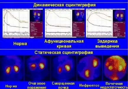 Tipuri de scintigrafie renale, indicații pentru, pregătirea, modul de a efectua procedura