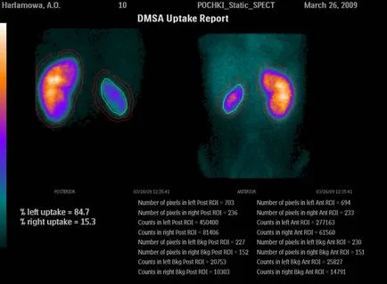 Бъбречните видове сцинтиграфия индикации