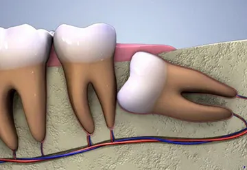 Fistula asupra gingiilor copilului - cauzele și posibilele complicații