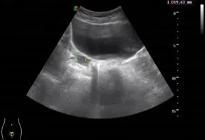Hüvelyi kismedencei ultrahang (intravaginális, intravaginális)