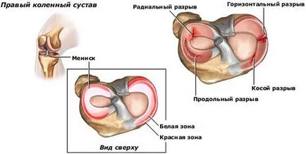 Eltávolítása a meniszkusz a térdízület hatások és helyreállítását a térd