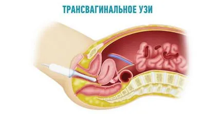 ecografie transvaginala - pregătire, indicații, reguli atunci când faci