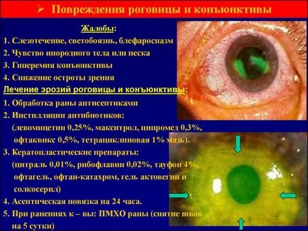 Нараняване или повреда на роговицата - симптоми и лечение на очни капки