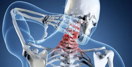 Unkovertebralny osteoarthritis a nyaki gerinc - azaz, a tünetek, a kezelés