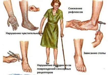 Полінейропатія верхніх і нижніх кінцівок симптоми і лікування (препарати) Полінейропатія верхніх і нижніх кінцівок симптоми і лікування