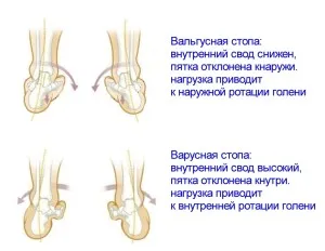 Варусна деформація стопи у дітей причини і лікування (деформація) Варусна деформація стопи у дітей причини і лікування