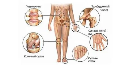 Típusai artritisz az ízületek - amelyek arthritis kezelési rend