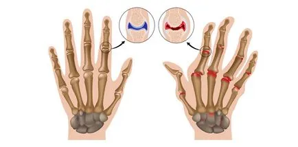 Típusai artritisz az ízületek - amelyek arthritis kezelési rend