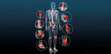 Típusai artritisz az ízületek - amelyek arthritis kezelési rend