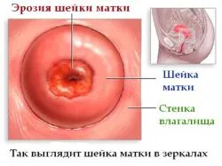 Problema dacă însoțită de polipi de col uterin, eroziunea de col uterin