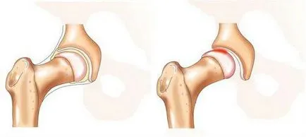 Dislocare de sold (congenital si protezare), tratament, simptome