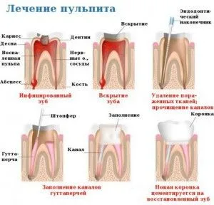 Хронична гангренясваща пулпит и нейното лечение