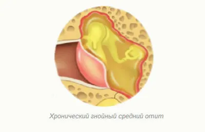 Krónikus középfülgyulladás kezelésére, a tünetek, okok és a megelőzés