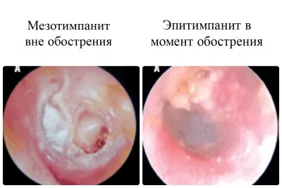 Tratament cronic otita medie, simptome, cauze și prevenire