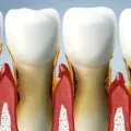 Fogkrém periodontitissel, paszta parodontitis (fotó és videó)
