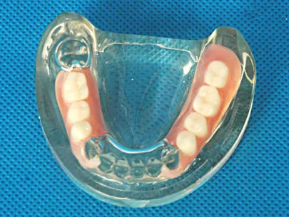 Найлон зъбни протези показания, предимства и недостатъци