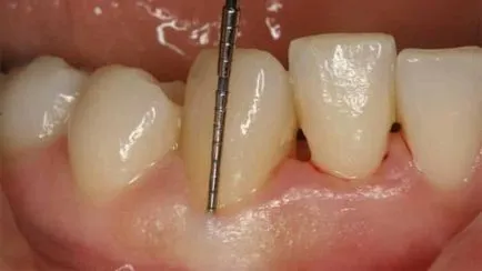 Pasta de dinti de boala parodontală și în parodontită