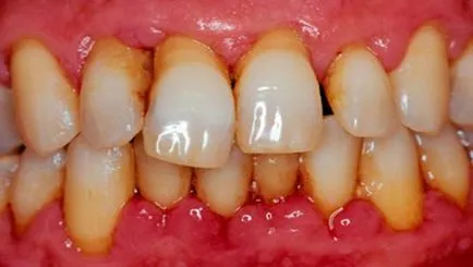 Fogkrém periodontitissel mi jobban vigyázzon a fogak és az íny