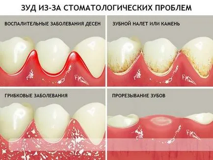 видове Сърбеж венците, причини и лечение на възрастни и деца