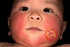 Allergia, hogy rávegyék - egy gyermek allergia