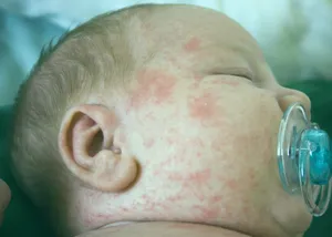 Алергия към САБ симплекс при кърмачета симптоми на алергия при бебетата