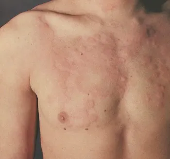Алергия към хлор - симптоми, лечение, снимки