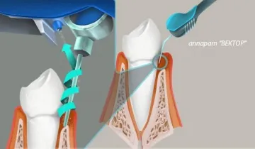 Векторът на единица за лечение на пародонтит - принцип на работа, предимства, мнения и цената