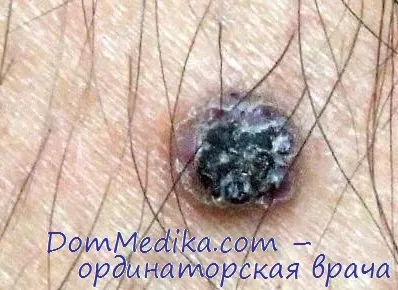 Angiokeratoma - diagnostic, tratament