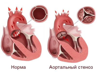 Cauzele aortic defect cardiac și tratamente