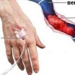 Постін'єкційних флебіт причини, симптоми, діагностика, лікування