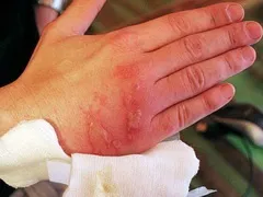 наслідки опіків