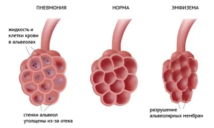 Наслідки пневмонії у дорослих (дорослих) Наслідки пневмонії у дорослих
