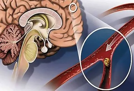 Церебрални симптоми атеросклероза и лечение, церебрална, че е