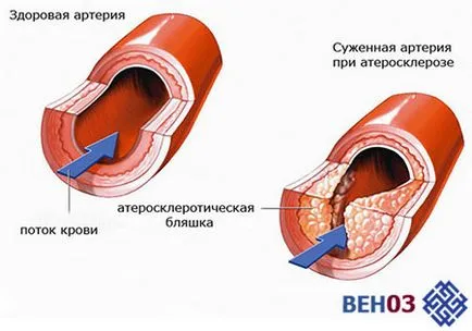 Arteriosclerosis, az alsó végtagok kezelt artériák tünetek