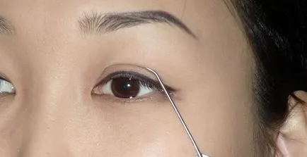 ochi din Asia Blefaroplastia (plastic) - Poze inainte si dupa, comentarii, după corectare, pret